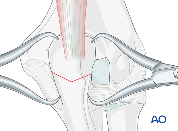 Reduce and hold the osteotomy with pointed reduction forceps to apply compression.