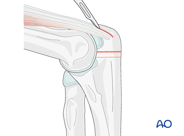 Incise the distal triceps in line with the ulna down to the bone to allow the plate to sit closer to the olecranon tip.