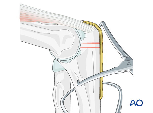 Apply the plate to the dorsal aspect of the olecranon and use forceps to maintain its position.