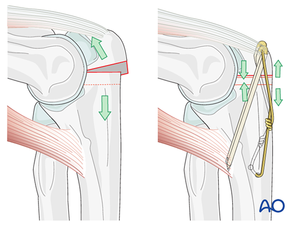 Tension band principle for fixation of olecranon osteotomy