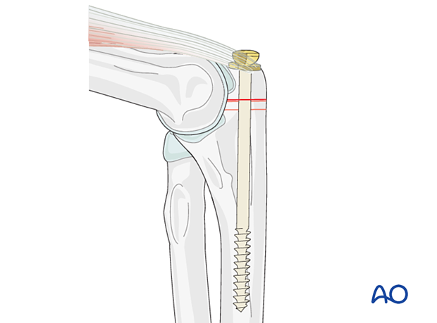 Intramedullary screw fixation of olecranon osteotomy