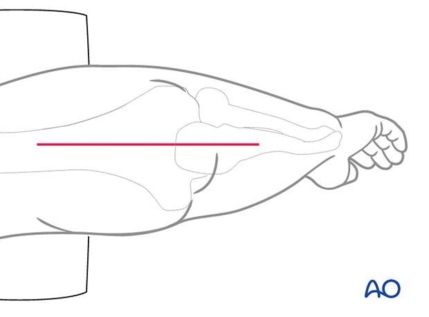 Posterior exposure of the elbow