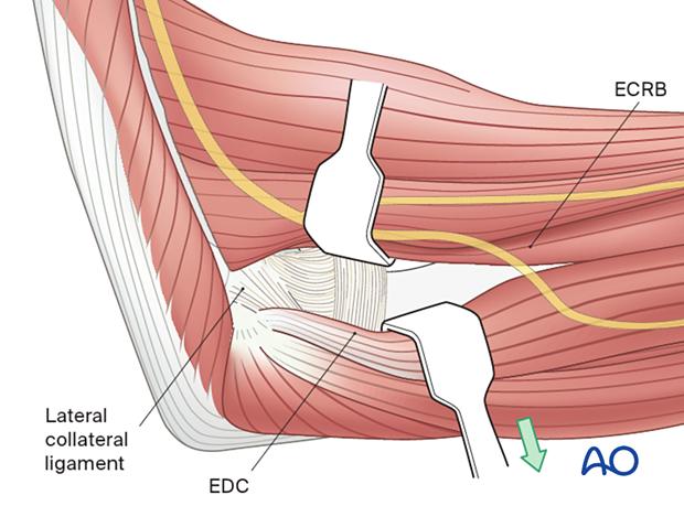 Open the interval between extensor carpi radialis brevis and extensor digitorum communis.