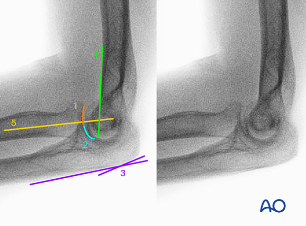 Anatomical landmarks and lines AP view of distal humerus