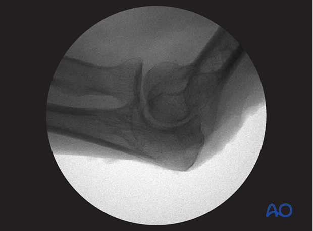 Verification of optimal oblique view