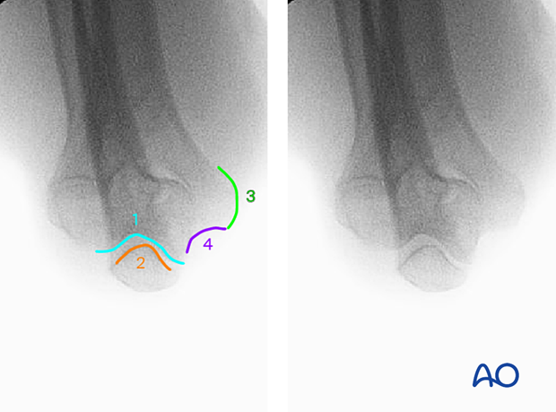 Anatomical landmarks and lines in the axial view