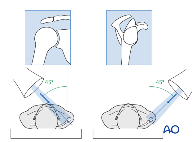 orif lag screw fixation