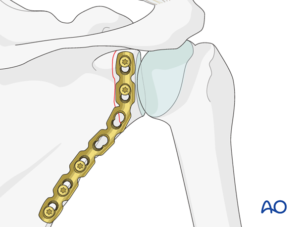 glenoid fossa extraarticular simple