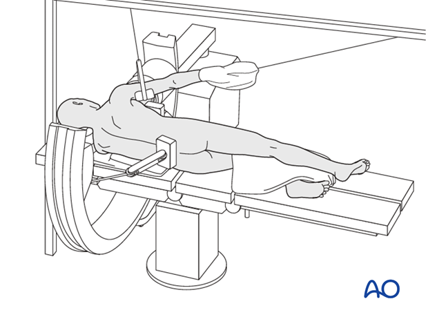 floating shoulder sequence of repair