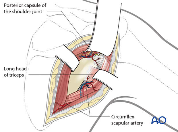 The interval between the infraspinatus and the teres minor is identified.