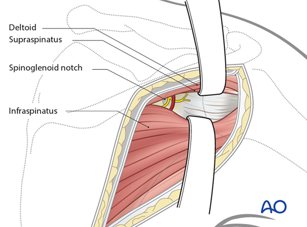 Exposure of the superior part of the articular segment and glenoid rim can be performed through the interval between the supraspinatus and infraspinatus