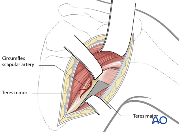 The interval between teres minor and teres major is identified by exposure of the circumflex scapular vessels.