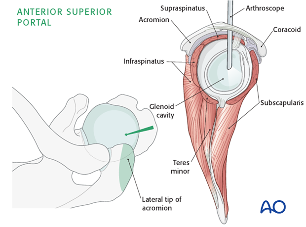 Anterior superior standard portal