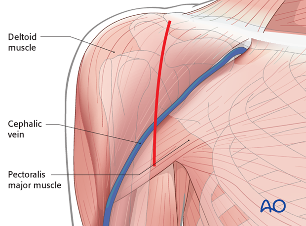 Skin incision