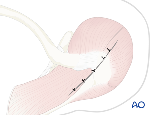 Wound closure