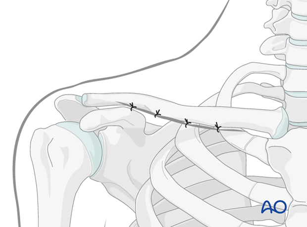 anterior approach