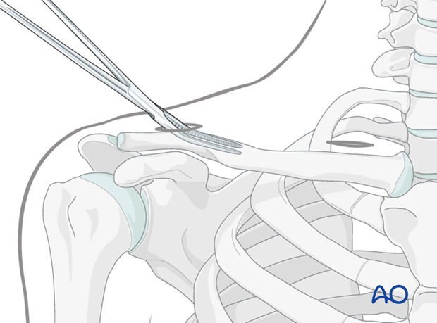 mipo   anterior approach