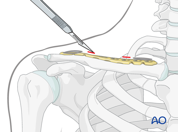 mipo   anterior approach