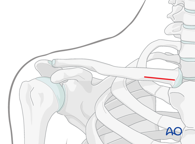 flexible intramedullary nail