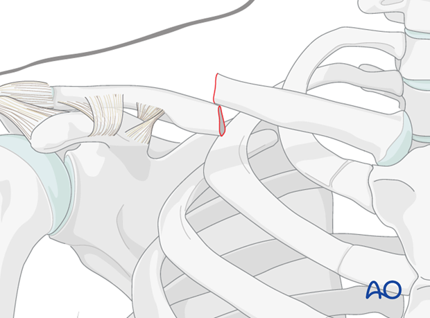 orif compression plate