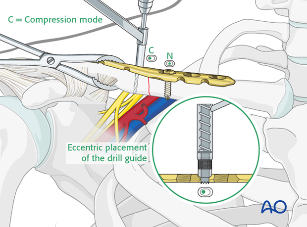 orif compression plate