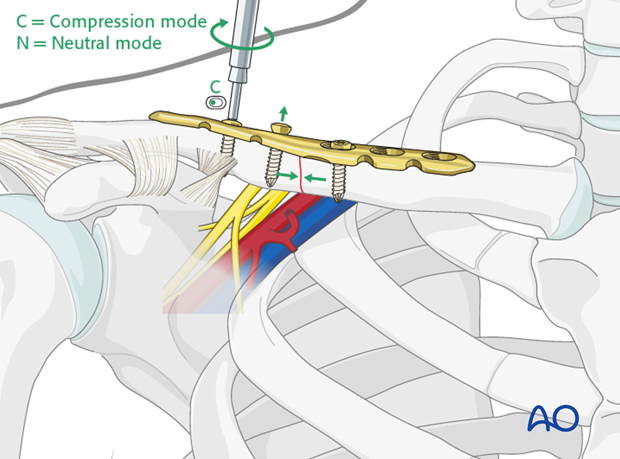 orif compression plate