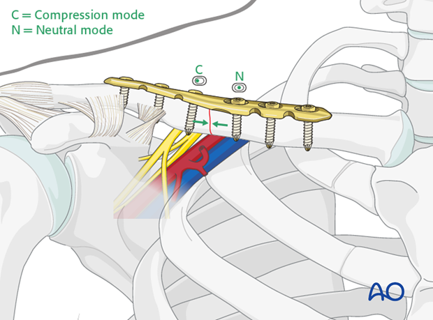 diaphyseal simple transverse