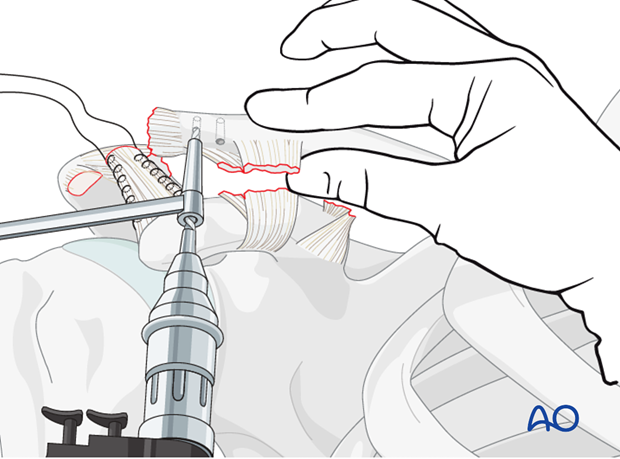 ligament reconstruction