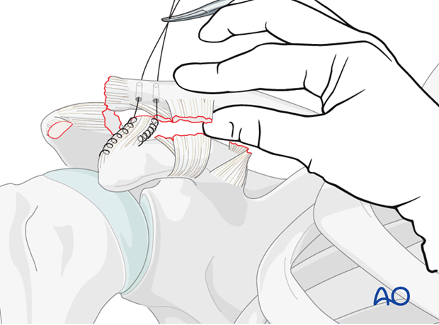 ligament reconstruction