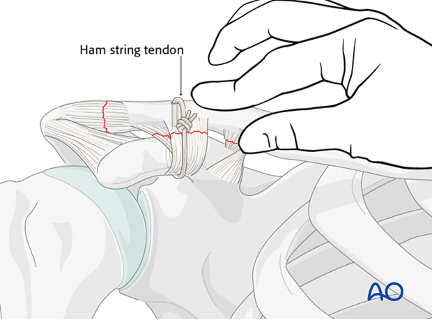 ligament reconstruction