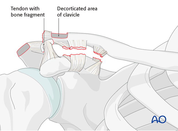 ligament reconstruction