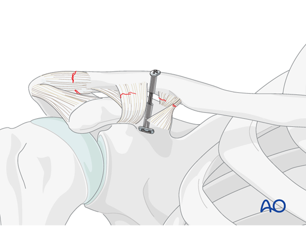 ligament reconstruction