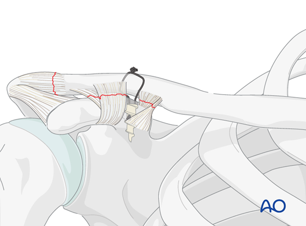 ligament reconstruction