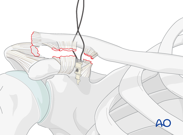 ligament reconstruction