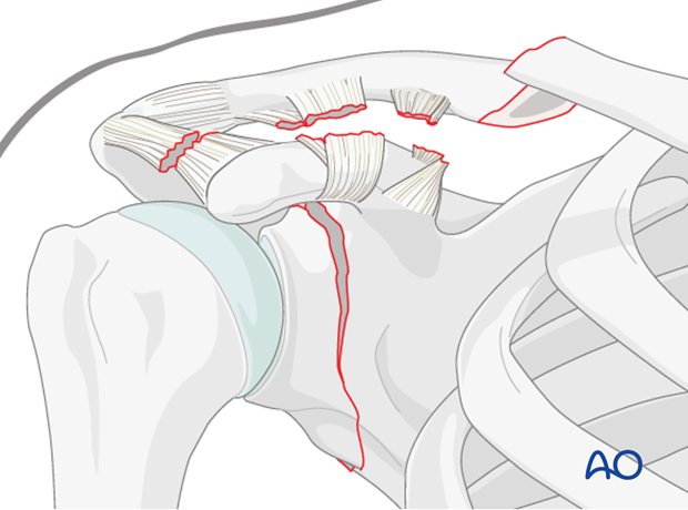 floating shoulder sequence of repair