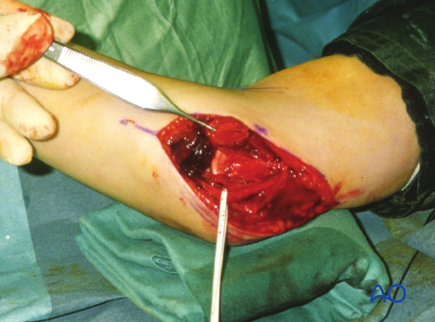 Boyd approach – Osteotomy of medial humeral epicondyle