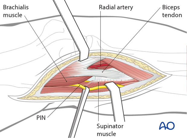 anterior approach