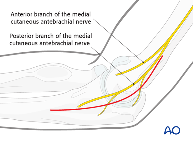 medial hotchkiss over the top