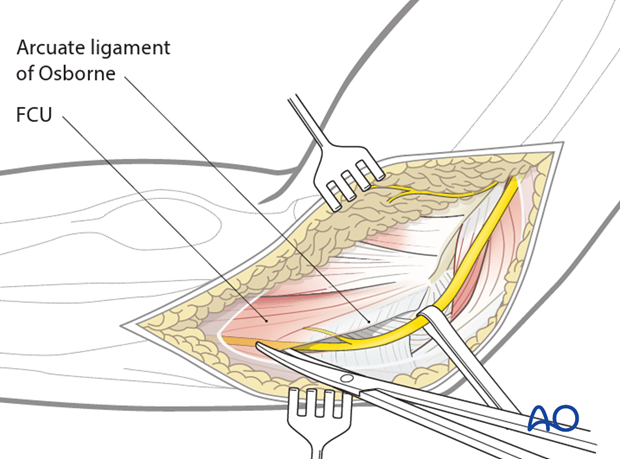 medial hotchkiss over the top