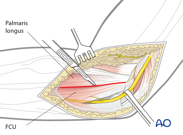 medial hotchkiss over the top