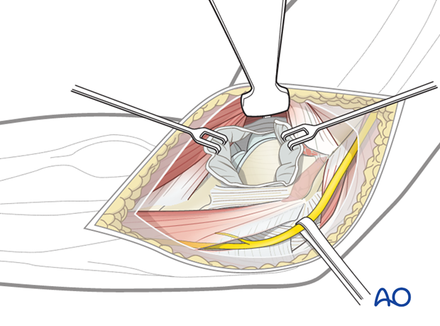 medial hotchkiss over the top