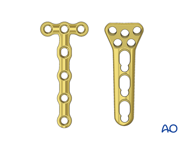 Complete radial head – Lag screw through plate – Plate selection