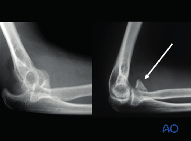 repair of coronoid fracture