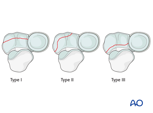 repair of coronoid fracture