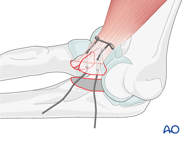 repair of coronoid fracture