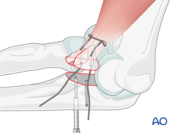 repair of coronoid fracture