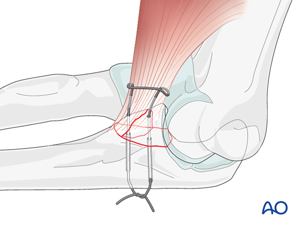 repair of coronoid fracture