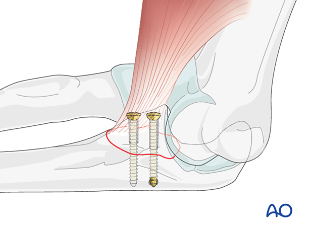 repair of coronoid fracture