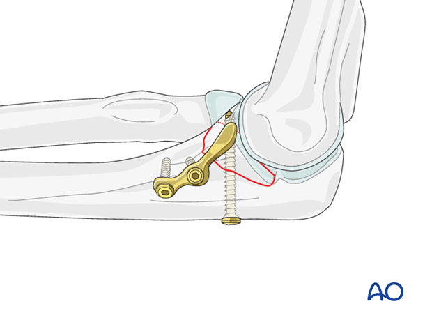 repair of coronoid fracture