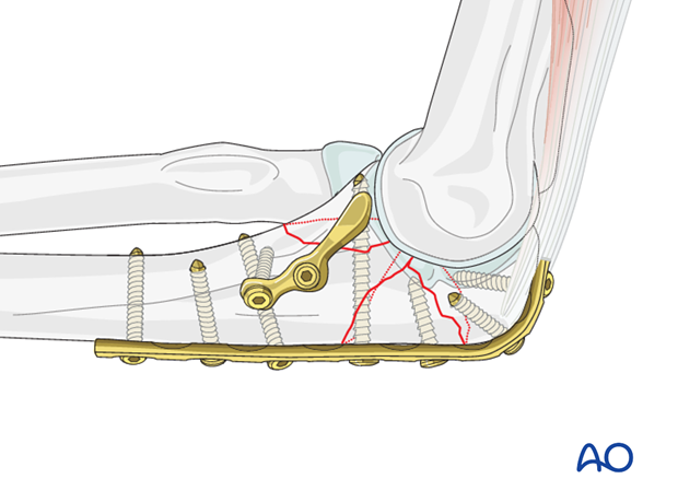 repair of coronoid fracture